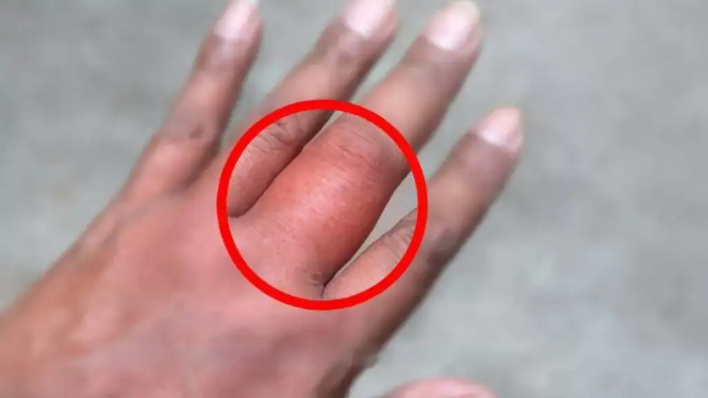 手指受到外力後腫脹、變形如蘿蔔,是典型的手指挫傷現象